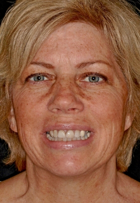 Porcelain Veneers Before