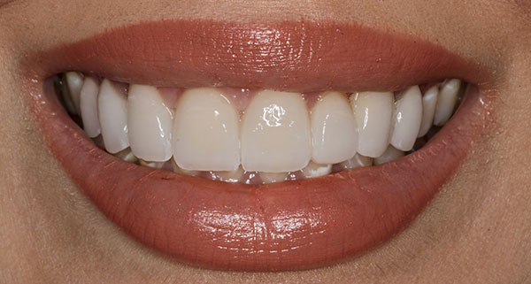 porcelain veneers after