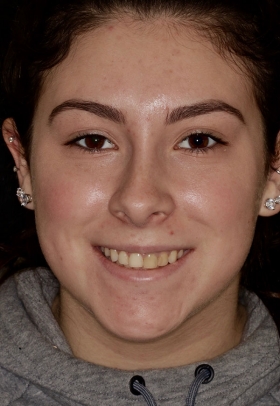 Porcelain Veneers Before