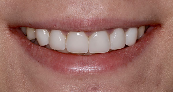 porcelain veneers after