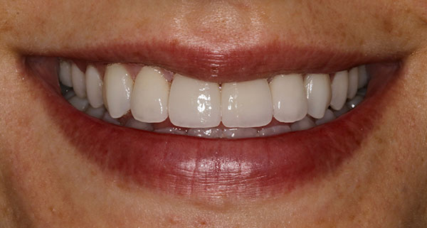 porcelain veneers after