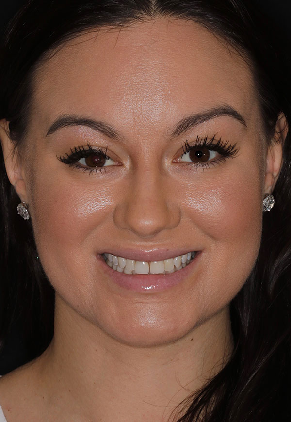 Porcelain Veneers Photos NYC - Portrait Before Women Patient 70