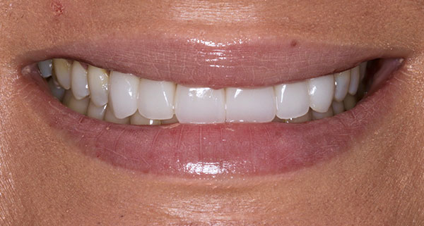 porcelain veneers after