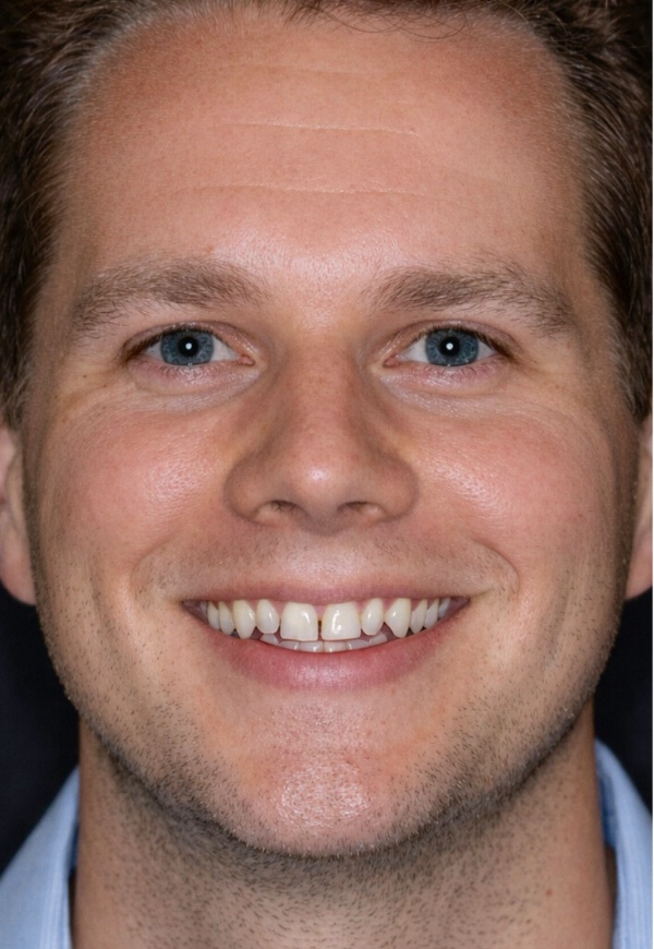 Porcelain Veneers Photos NYC - Portrait 1 Before Men Patient 3
