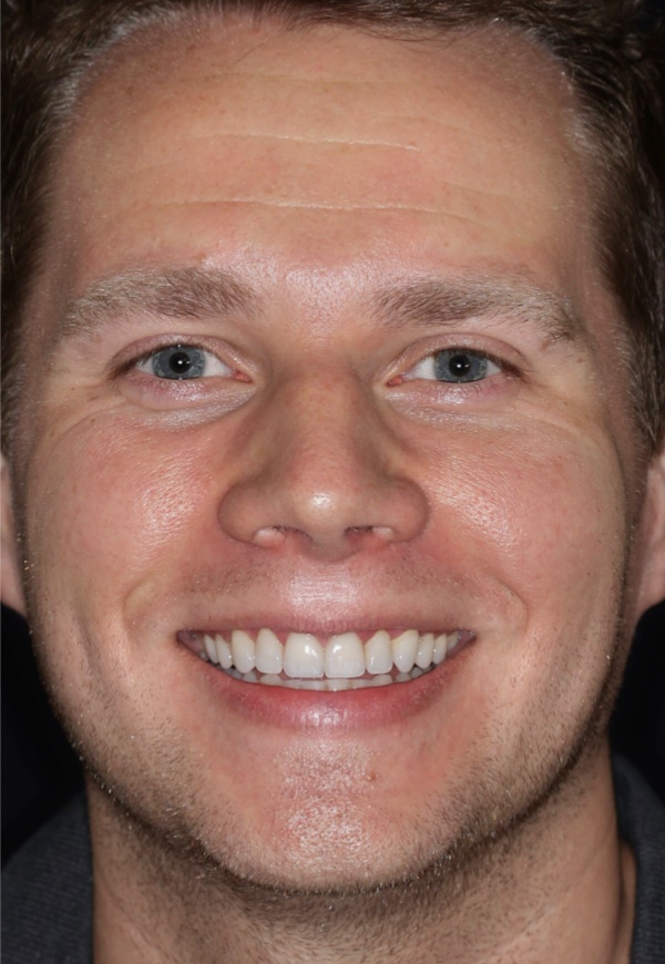 porcelain veneers after