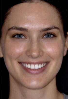 Porcelain Veneers After