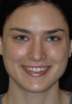 Porcelain Veneers Before