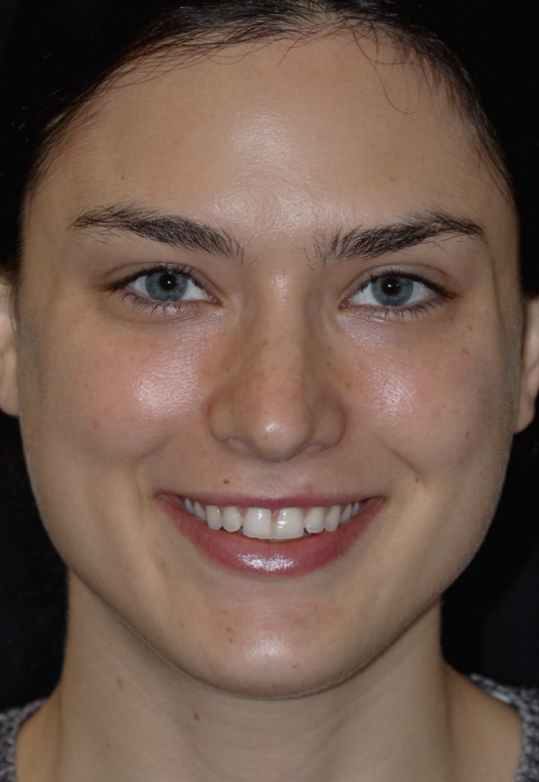 Porcelain Veneers Photos NYC - Portrait Before Women Patient 108