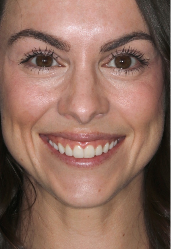 Porcelain Veneers Photos NYC - Portrait1 Before Women Patient 71