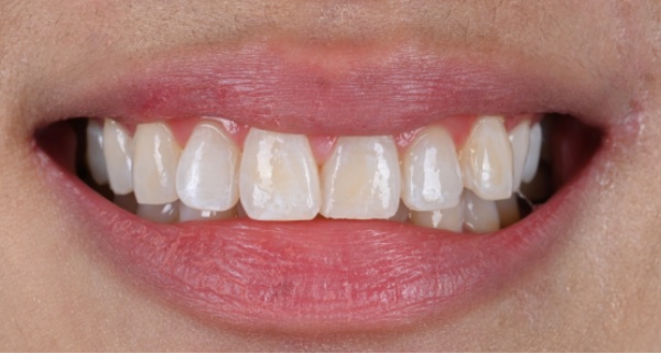 Porcelain Veneers Photos NYC - Portrait Before Natural Smiles Patient 54