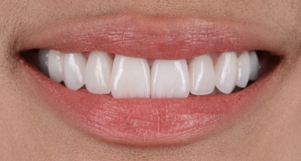 porcelain veneers after
