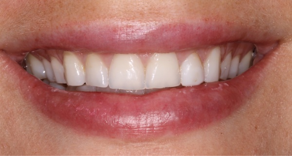 Porcelain Veneers Photos NYC - Portrait Before Natural Smiles Patient 55