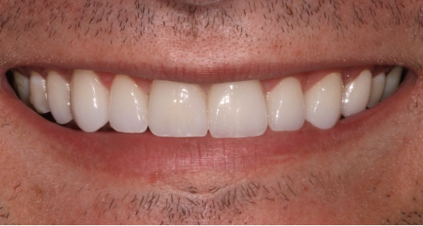 porcelain veneers after