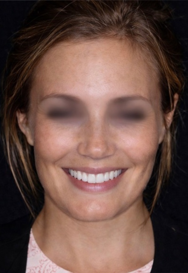 porcelain veneers after