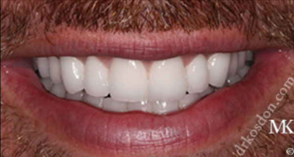 porcelain veneers after