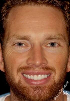 Porcelain Veneers After