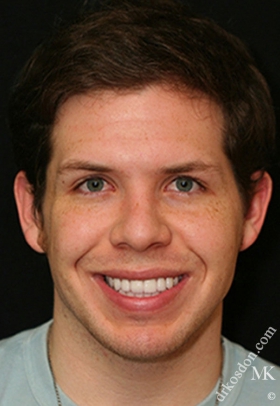 Porcelain Veneers After