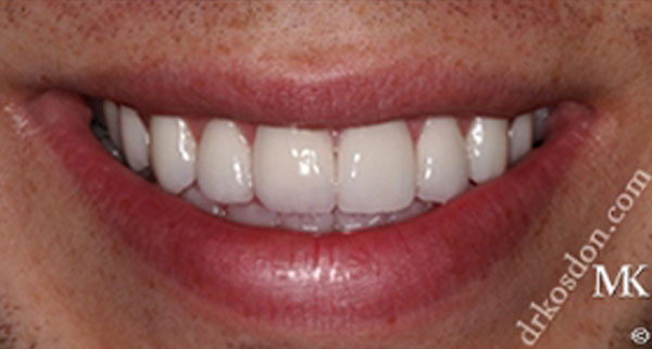 porcelain veneers after