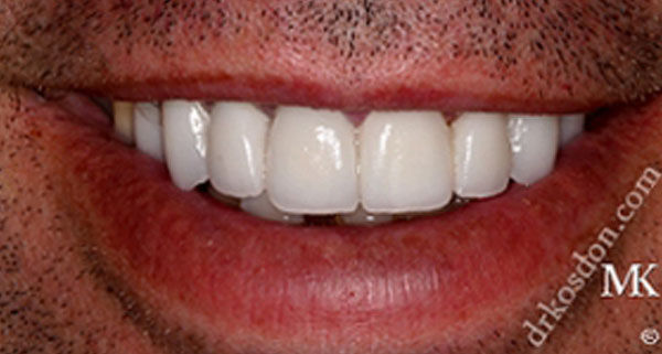 porcelain veneers after