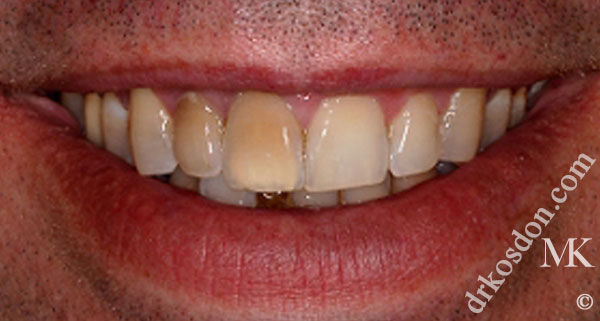 porcelain veneers before