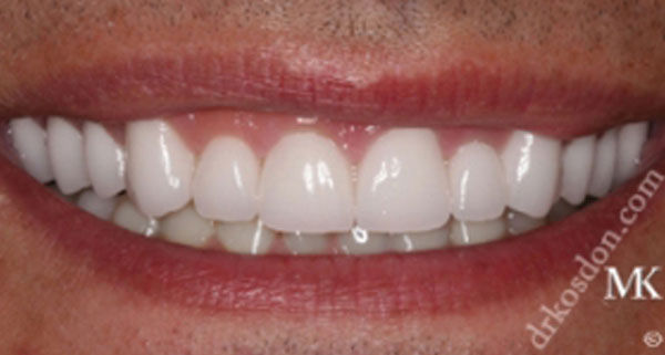 porcelain veneers after