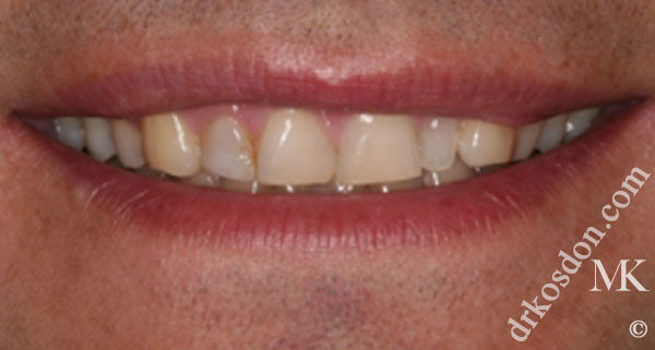 porcelain veneers before