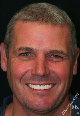 Porcelain Veneers After