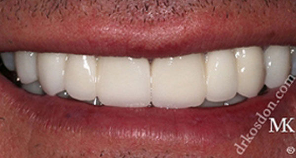 porcelain veneers after