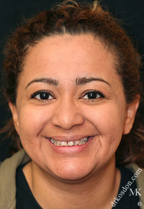 Porcelain Veneers Photos NYC - Portrait Before Women Patient 47