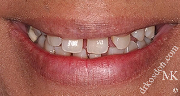 Porcelain Veneers Photos NYC - Smile Before Women Patient 47