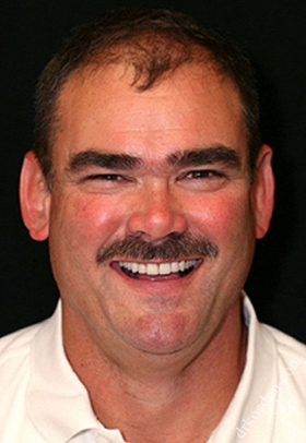 Porcelain Veneers After