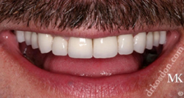 porcelain veneers after