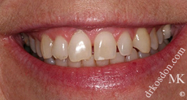 porcelain veneers before