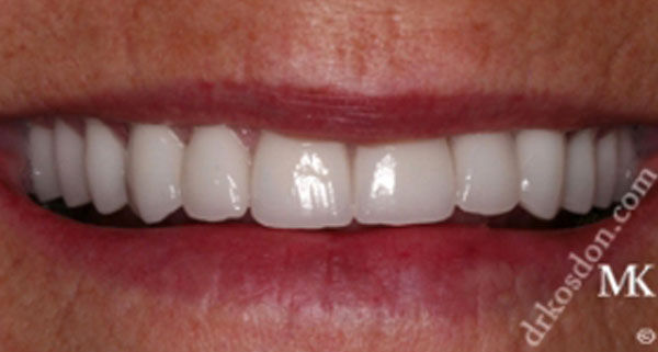 porcelain veneers after