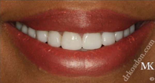 porcelain veneers after