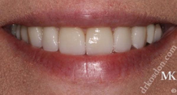 porcelain veneers after