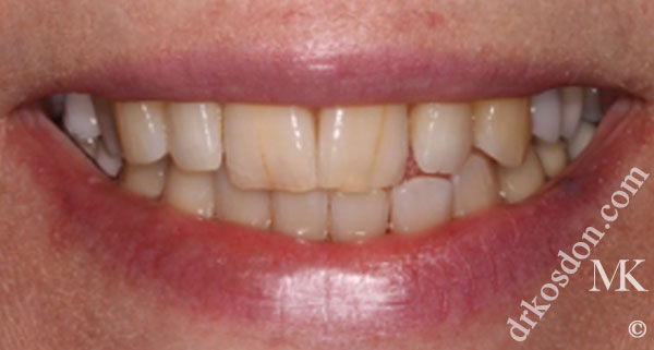 porcelain veneers before