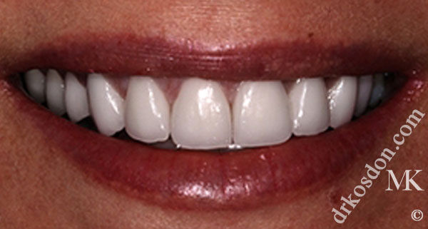 porcelain veneers after