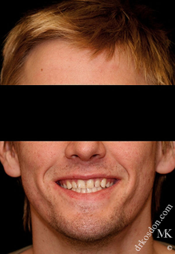 Porcelain Veneers Photos NYC - Portrait Before Men Patient 2