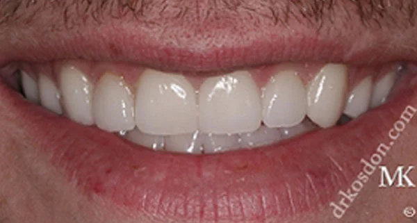 porcelain veneers after