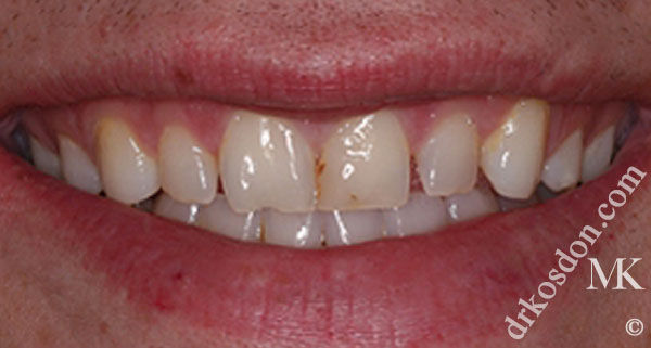 porcelain veneers before