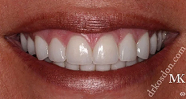 porcelain veneers after