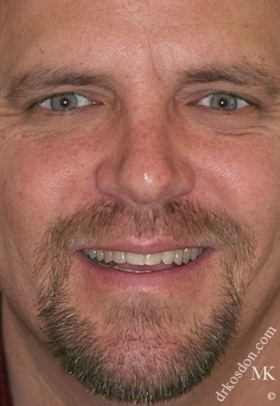 Porcelain Veneers Before