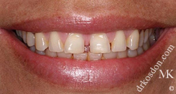 porcelain veneers before