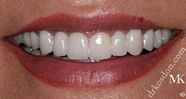 porcelain veneers after