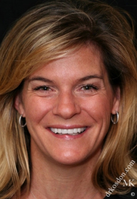 Porcelain Veneers After