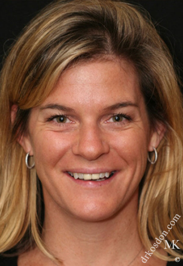 Porcelain Veneers Photos NYC - Portrait Before Women Patient 42