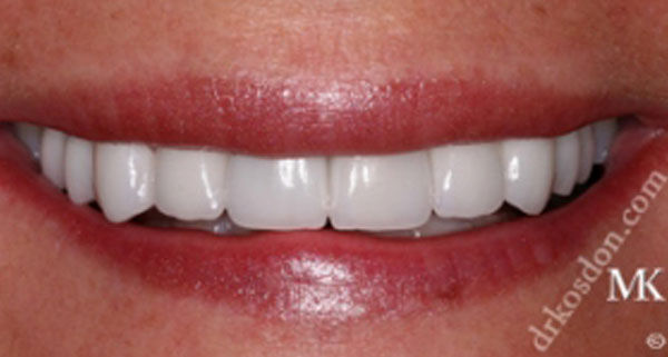 porcelain veneers after