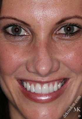 Porcelain Veneers After