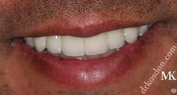 porcelain veneers after